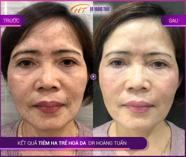 Kết quả tiêm HA tại Thẩm mỹ Hoàng Tuấn